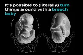 Image result for Breech Presentation