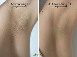 Nach meiner erfahrung könnest du bereits früher signifikante veränderungen sehen. Fur Immer Haarfrei Ipl Gerate Fur Zuhause 2021 Test Erfahrungen