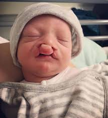 Mum with cleft lip and palate speaks of agony after son was born with the  same condition