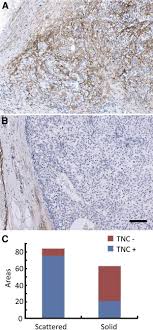 The alkaline diet is where an individual consumes food and drink that is categorized as alkaline. Tenascin C Induces Epithelial Mesenchymal Transition Like Change Accompanied By Src Activation And Focal Adhesion Kinase Phosphorylation In Human Breast Cancer Cells The American Journal Of Pathology