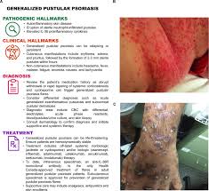 Image result for Pustular Psoriasis