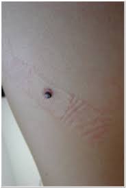 Flat, firm, pale or yellow areas, similar to a scar raised reddish patches that might be itchy small, pink or red, translucent, shiny, pearly bumps, which might have blue, brown, or black areas Does Nodular Melanoma Look Like A Blood Blister Best Reviews