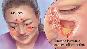 elimine rinite e sinusite rapidamente com este simples metodo com um ingrediente muito comum cura pela natureza sinusitis sinus remedies sinus infection