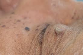 How to remove skin tag on eyelid. 5 Home Remedies To Remove Skin Tags On Eyelids Metdaan