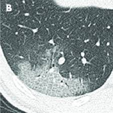 Pdf Time Course Of Lung Changes On Chest Ct During Recovery From 2019 Novel Coronavirus Covid 19 Pneumonia
