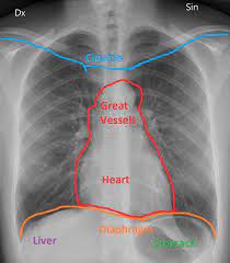 Anatomy of chest x ray. Radiology Normal Chest X Rays Glass Box