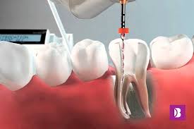 Endodoncija Poliklinika B Dent Zagreb