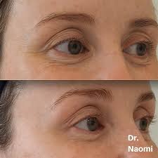 Softer tear trough fillers made of hyaluronic acid, such as restylane or juvederm ultra, can relieve the tired, hollow. Eye Wrinkle Injections Best Clinic Sydney For Dermal Fillers