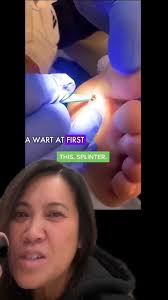 I'm still amazed by this... 👀 #drpimplepopper #popaholics #dermatology  #splinter #MedicalEducation