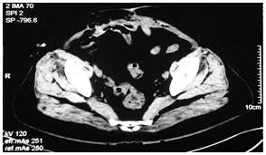 Radiology imaging sometimes will not pick up evidence of diffuse cancerous growths on the mesothelium, but will readily produce a shadow created by a single tumor that may occur more readily with peritoneal mesothelioma. Malignant Peritoneal Mesothelioma In A Patient With Intestinal Fistula Incisional Hernia And Abdominal Infection A Case Report