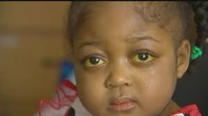 Girl with donated liver improving