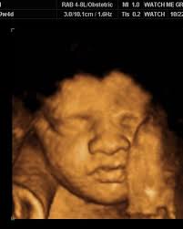 Today marks one year since our embryo transfer! What a whirlwind the past  12 months have been. I distinctly remember our transfer day, walking into  the clinic thinking “well here goes nothing”.