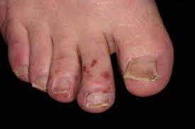 Image result for Chilblains