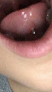 Frisches Zungenpiercing Entzundet Gesundheit Und Medizin