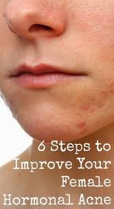 6 Steps To Prevent Female Hormonal Acne Hormonal Acne How To Get Rid Of Acne Skin Treatments