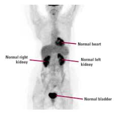 Pet scans are not used to screen women for breast cancer. Pet Scans Breastcancer Org