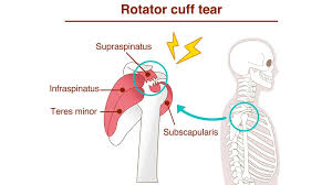 Image result for Shoulder Strength Exam