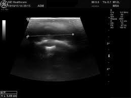 Image result for phlegmon on face)