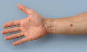 Die zahlen der menschen, die an krebs erkranken, ist am zunehmen. Krebs Kunstlicher Leberfleck Als Fruhwarnsystem Healthcare In Europe Com