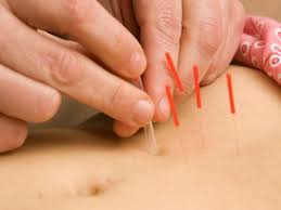 Acupuncture For Fertility Effectiveness Safety And Side
