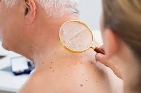 A persistent cough could be a symptom of lung cancer or head and neck cancer. Early Signs Of Melanoma Age Spot Or Skin Cancer