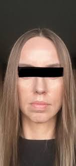 Amazing Difference After An 11k Nose Job …..🤣🤣🤣