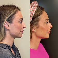 undereye growth factors 🤝🏻 biostimulators 🤝🏻 filler What do you get  when you trust the process?! This 🤩 Let's break it down: before and after  3 months apart Ariessence PDGF- growth factors