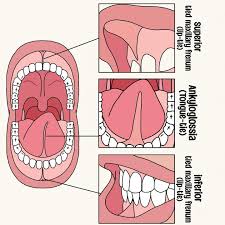 Image result for Ankyloglossia