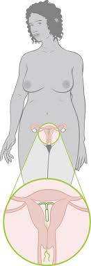 The insertion and removal of the iud may incur a cost, speak to your provider for more information. Iud Birth Control Method