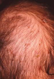 Rassman is a world leading expert in hair loss with over 25 years of experience and over 50,000 satisfied clients. Infestations Bites And Stings Plastic Surgery Key