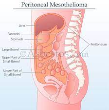 Getting a diagnosis of bladder cancer can be a difficult time. Mesothelioma Asbestos Images Diagrams Graphs