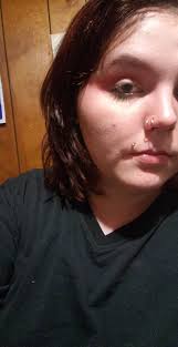 Broken nose from fainting due to uti