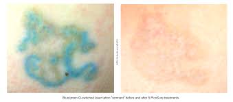 A keloid scar is a type of scar tissue that sometimes develops well after you sustained an injury. Pos Q Switched Lasers Scar Tattoo Removal Patients Austinpicosure Com A Tattoo Removal Nurse S Notes