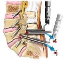 Intervertebral Diskectomy Information The Mount Sinai Hospital Surgery Spine Surgery Back Surgery
