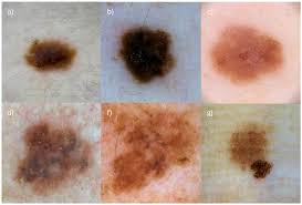 Image result for Dermoscopy