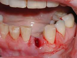 Image result for Tooth Extraction