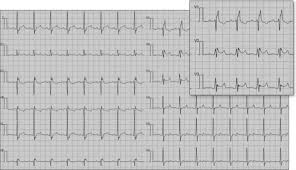 Image result for Epsilon Wave