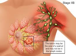 Keep in mind that this number does not take into account your age, general health, treatment response and hpv 16 status. Breast Cancer Signs Symptoms Stages Treatment About Risk Factors Ashray