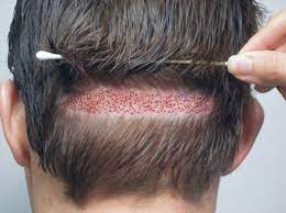 Check spelling or type a new query. Hair Transplant Cost In Bangalore India 30 Years Expertise In Hair Transplantation