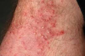 Image result for folliculitis symptoms