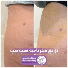 تزریق فیلر بادی یا فیلر بدن در شیراز - کلینیک لیان