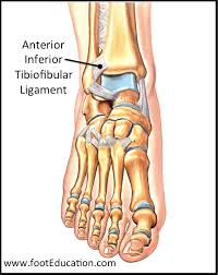 An acute sprain occurred recently—usually within the past few weeks—and is in an active stage of healing. Ankle Sprains Orthopaedia