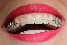 The inman aligner is the perfect solution for crowding or protrusion of the front teeth. Inman Aligner Dentist Vuic
