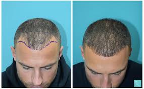 Procedures such as follicular unit hair transplantation (fut or fue), hairline lowering (aka scalp advancement), or indeed any significant surgery (especially those requiring general anesthesia) can cause this temporary shedding of hair. Mike Thurston 1 Year Results Before After Fue Hair Transplant 1700 Grafts Video Dr Raghu Reddy