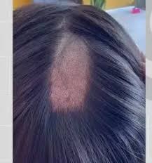 Mulher denuncia falha em exame toxicológico para CNH após ter parte do cabelo raspada