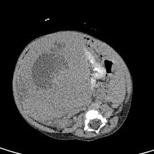The Claw Sign Is Useful In Determining Whether A Mass Arises From A Solid Structure Or Is Located Adjacent To It And Distorts The Ou Radiology Tumor Pediatrics