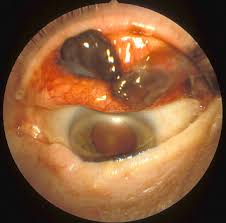Image result for lesion sclera
