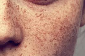 Update your find a dermatologist profile, the academy's directory that's visited by over 1 million people a year. The Difference Between Melasma And Other Skin Spots The Healthy