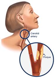 Image result for carotid artery