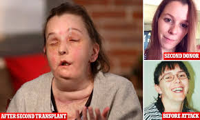 First American to have second face transplant shows off new face